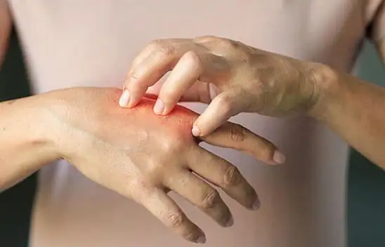 Güneş Alerjisi Ve Güneş Çarpmasına Karşı Korunmanın Yolları Nelerdir?