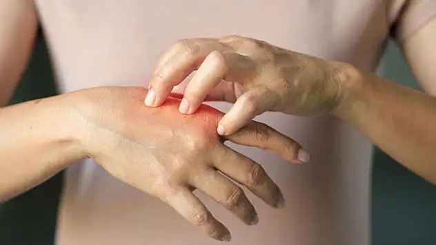 Güneş Alerjisi Ve Güneş Çarpmasına Karşı Korunmanın Yolları Nelerdir?