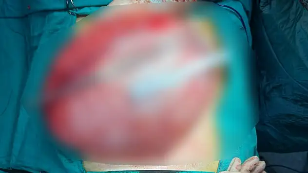 14 Yaşındaki Öğrencinin Karnından 3,5 Kiloluk Kist Çıktı
