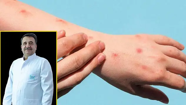 Maymun Çiçeği Anne Karnındaki Bebeğe Geçer Mi?