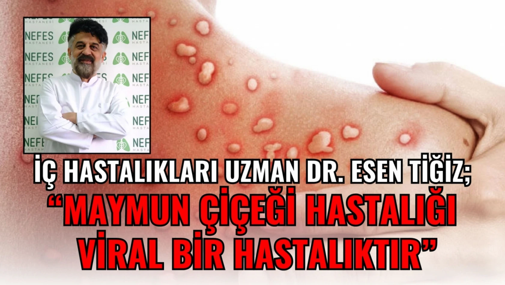 Uzman Dr. Tiğiz: 'Maymun Çiçeği Hastalığı Viral Bir Hastalıktır'