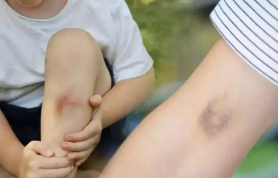 Cildiniz en küçük bir çarpmada bile morarıyorsa dikkat!