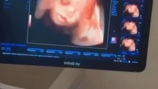 Sinop'a 4 Boyutlu Ultrason Cihazı