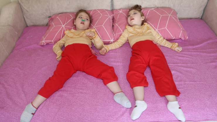 İkizlerin hastalığına teşhis konulamıyor