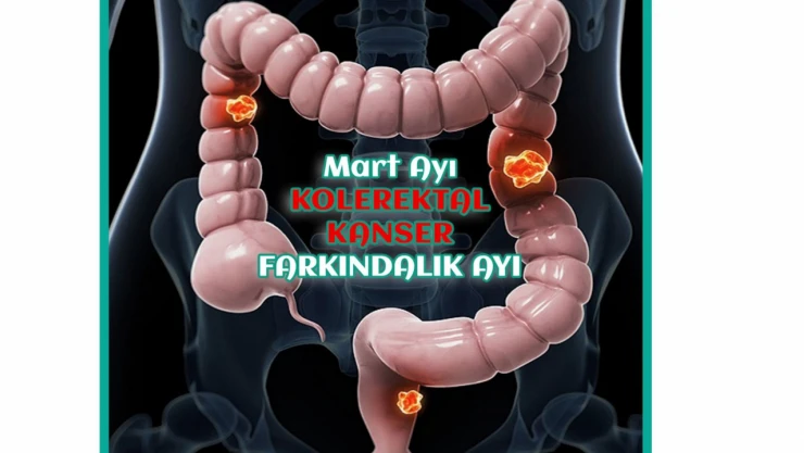 Kalın Bağırsak Kanseri Bilgilendirmesi