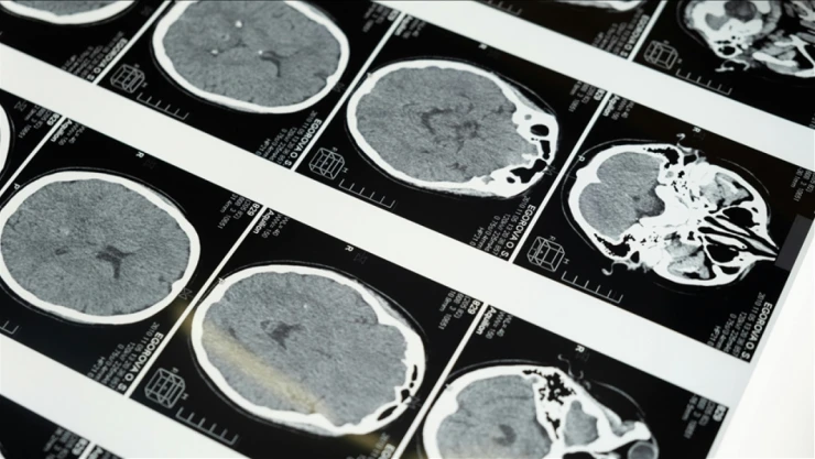 Konuşma Bozukluğu İnme Habercisi Olabilir