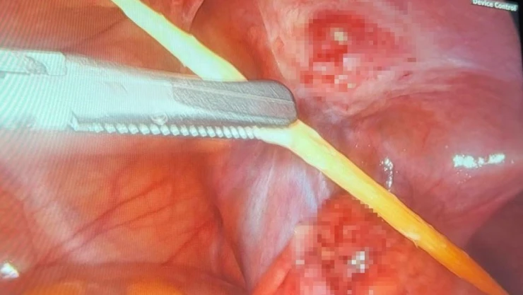 Kalın Bağırsağı Delen Kürdan Kapalı Yöntemle Çıkarıldı
