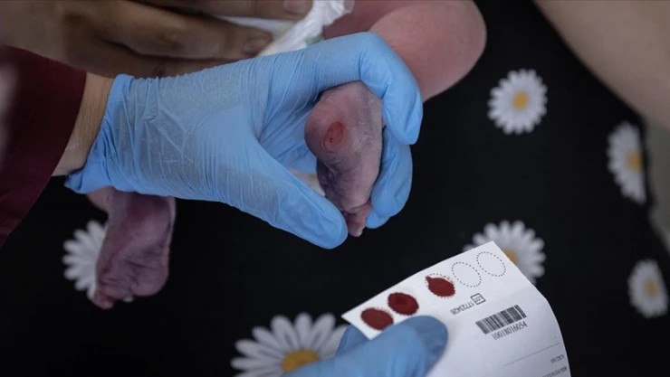 Türkiye'de Her 25 Kişiden Biri Fenilketonüri Taşıyıcısı